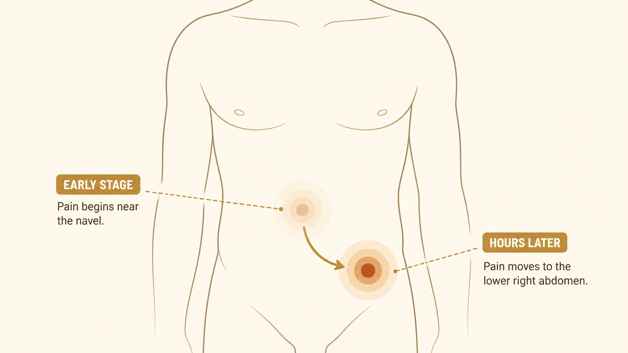 Medical illustration showing appendicitis pain migrating from near the belly button to the lower right abdomen over 12 to 24 hours