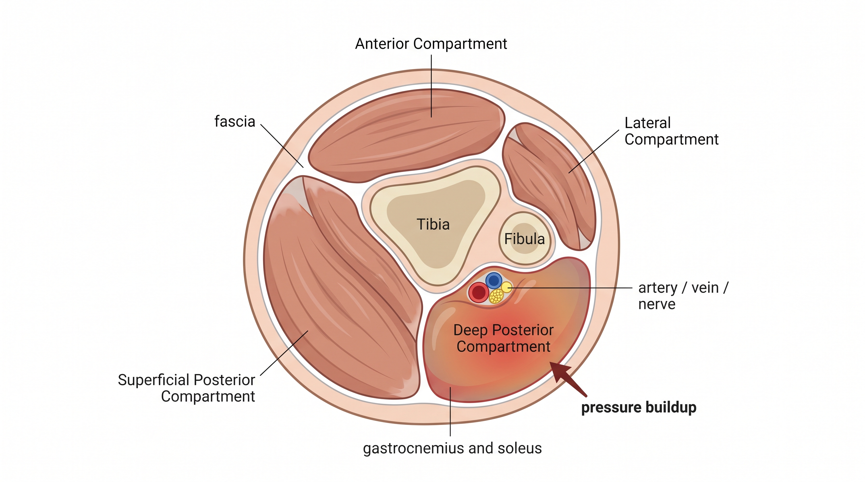 A labeled medical cross-section illustration of a lower leg showing four muscle compartments separated by fascia, with one compartment visually swollen and pressurized