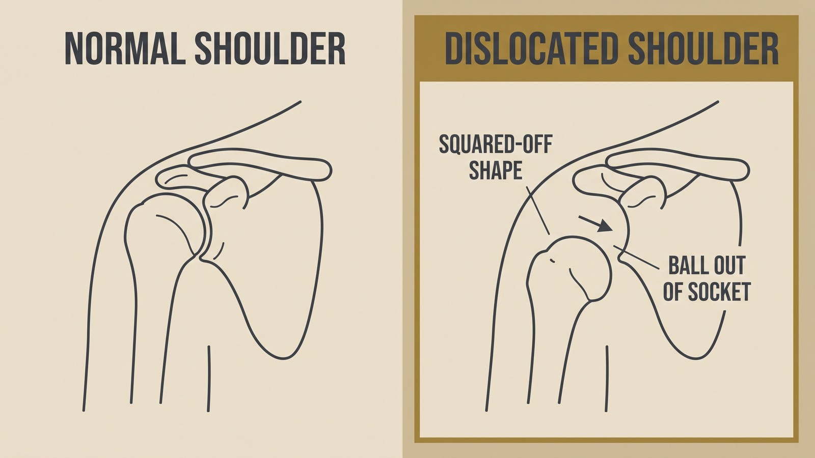 Illustration comparing a normal shoulder joint with a dislocated shoulder, showing the upper arm bone out of the socket