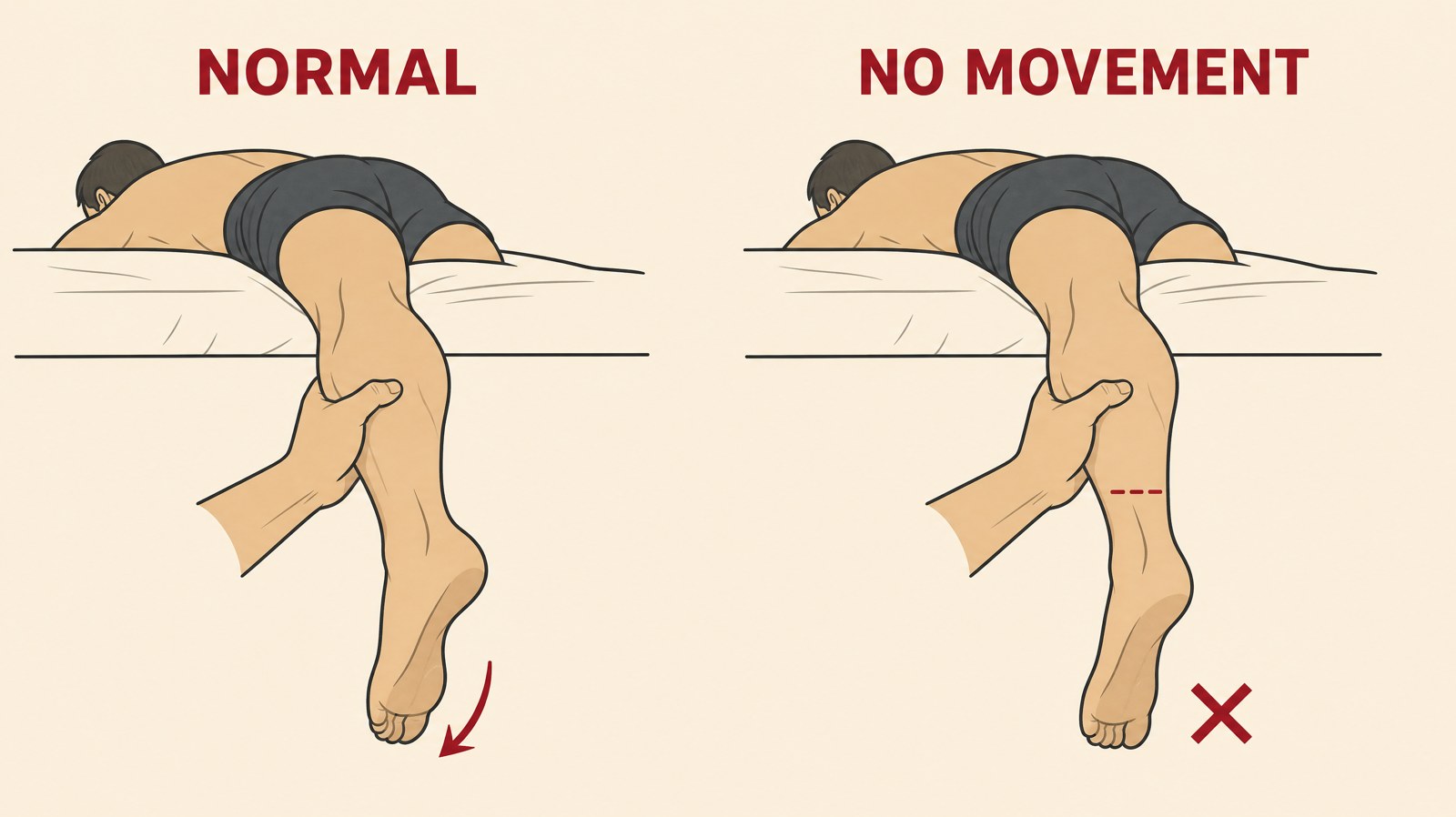 Two-panel instructional illustration of the calf squeeze test showing the foot pointing down normally on one side and staying limp on the other