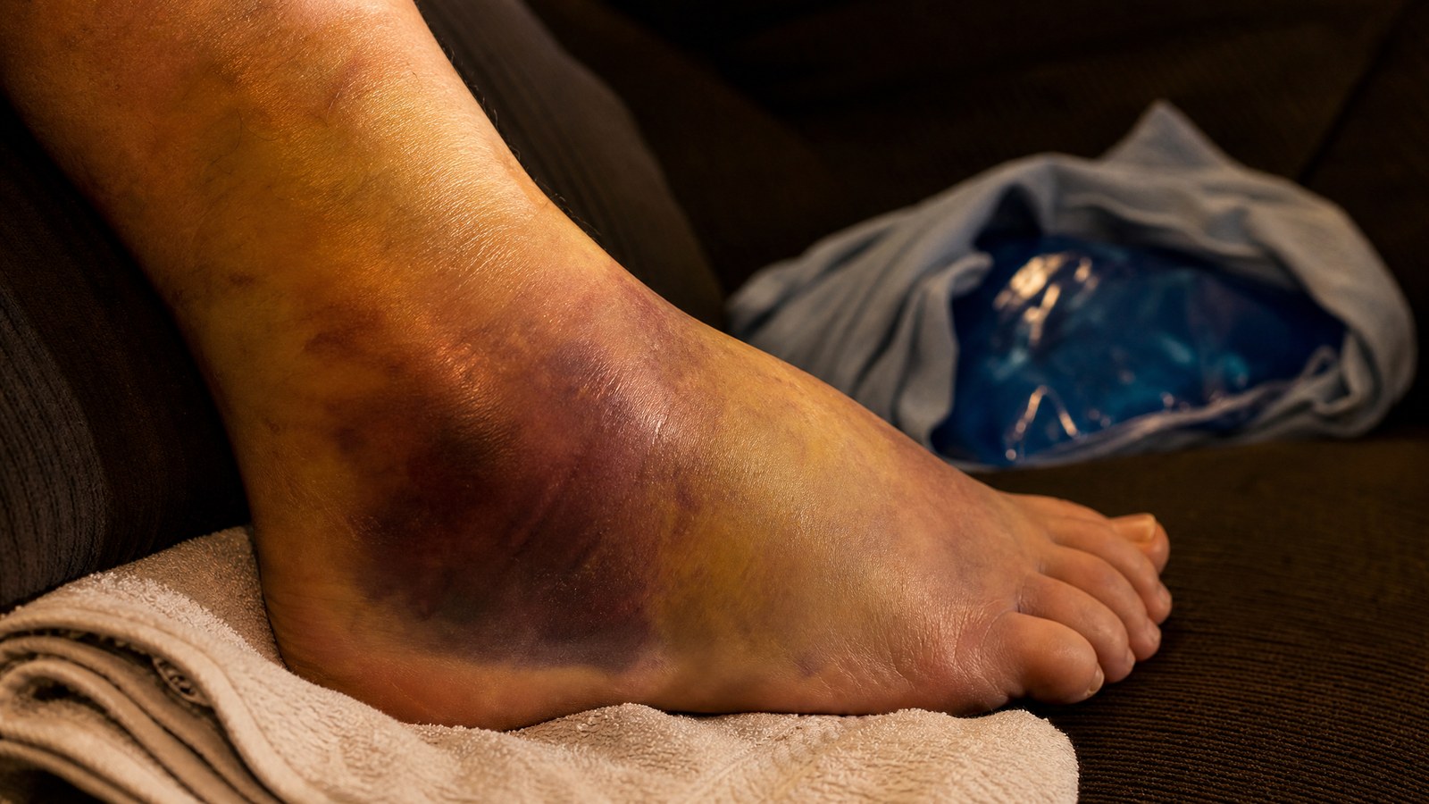 Close view of a badly swollen and deeply bruised adult ankle resting on a folded towel with an unused ice pack beside it
